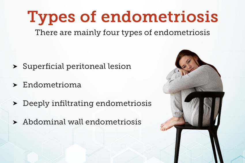 Endometriosis Causes, Symptoms, Treatments And More