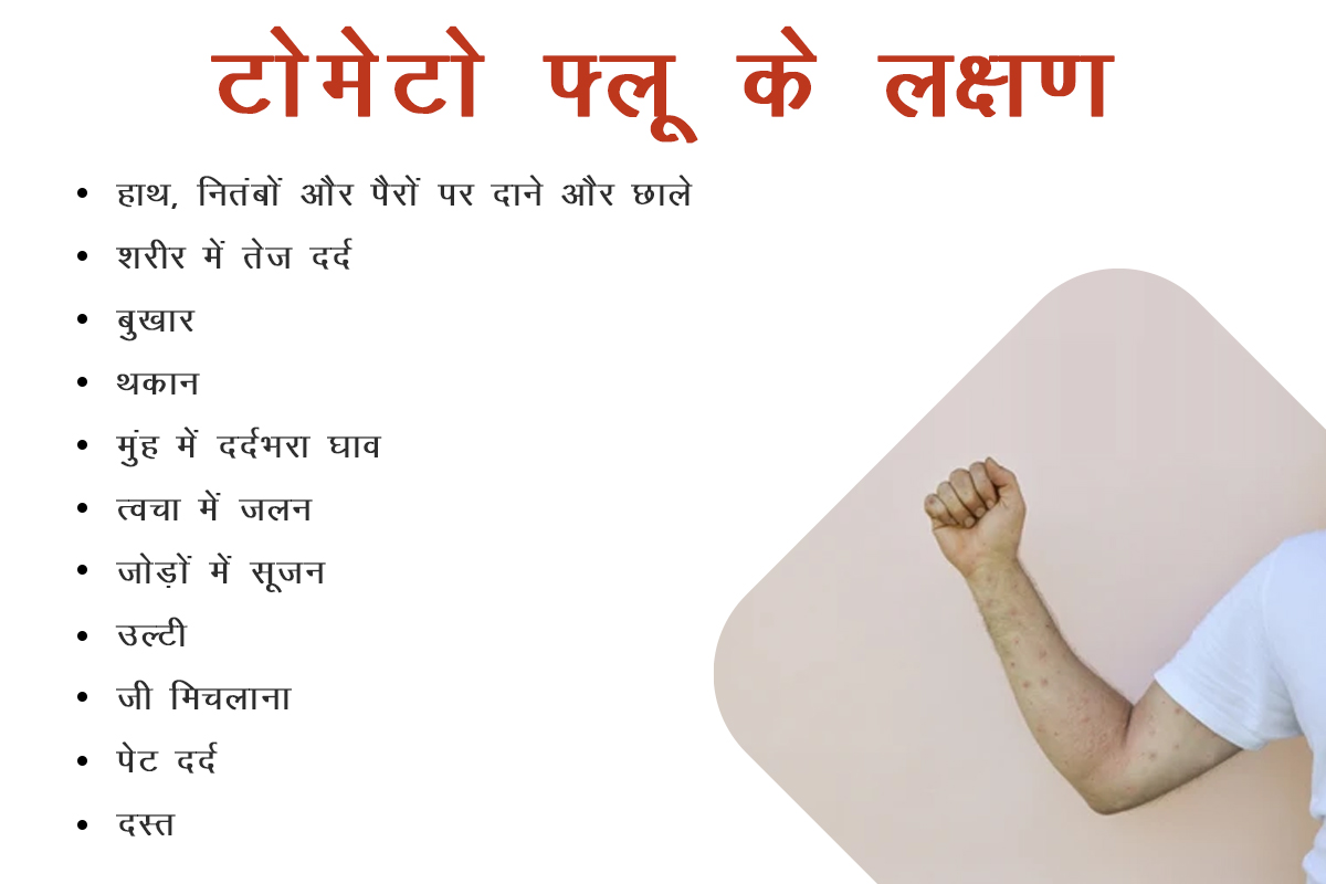 टोमेटो फ्लू के लक्षण