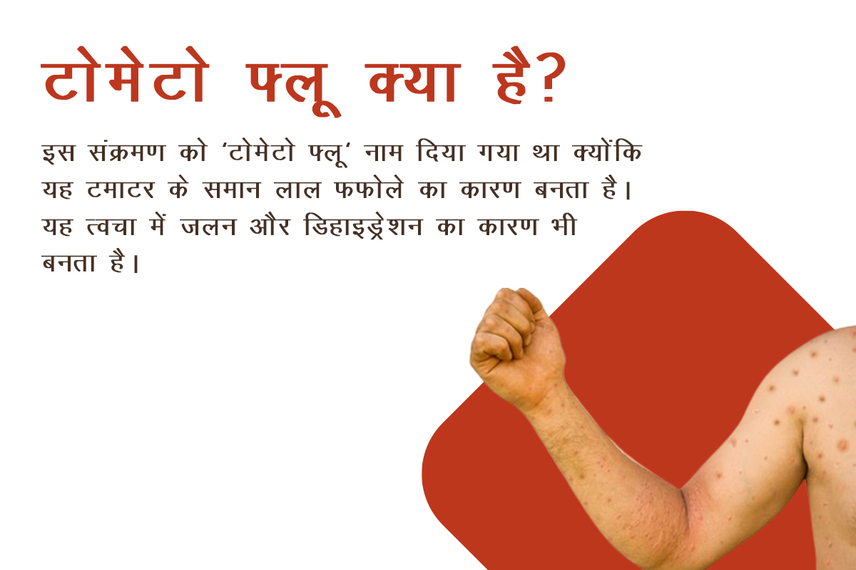 टोमेटो फ्लू क्या है?
