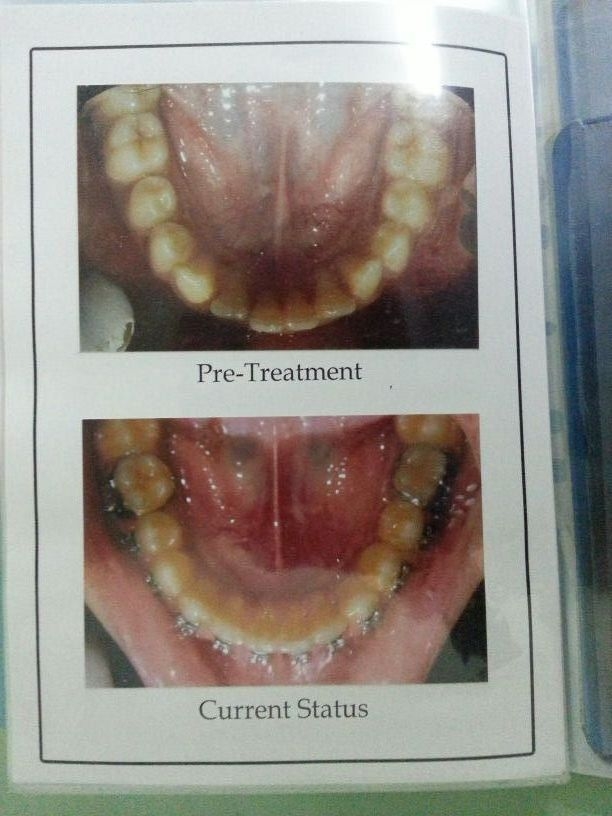 Dr.Ankit Khurana's CITY DENTAL CLINIC & IMPLANT CENTRE,(A Multispeciality Dental Clinic In Vidisha) Image 10