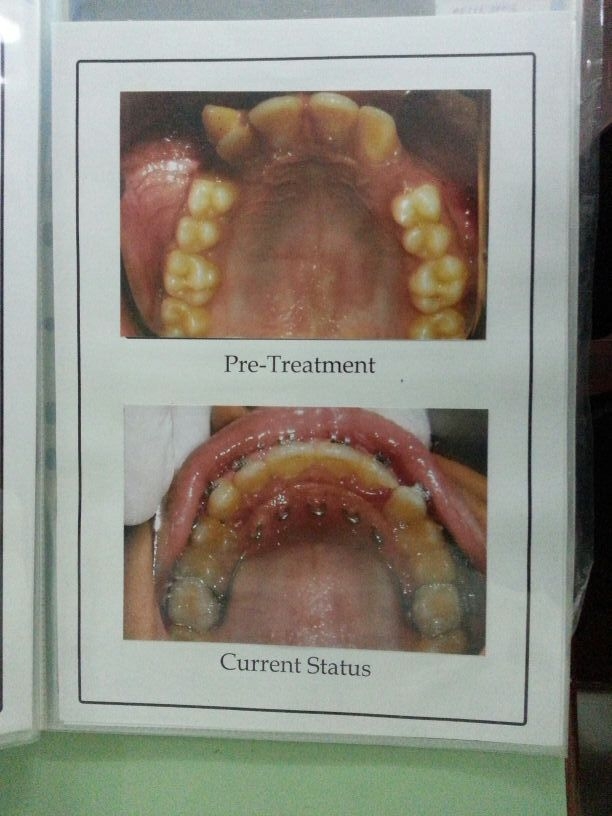 Dr.Ankit Khurana's CITY DENTAL CLINIC & IMPLANT CENTRE,(A Multispeciality Dental Clinic In Vidisha) Image 7