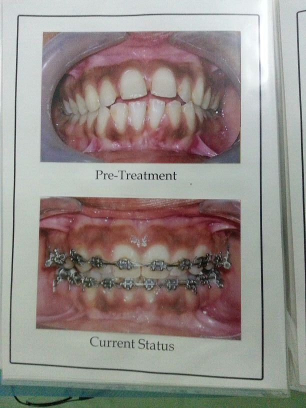 Dr.Ankit Khurana's CITY DENTAL CLINIC & IMPLANT CENTRE,(A Multispeciality Dental Clinic In Vidisha) Image 6