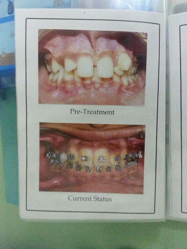 Dr.Ankit Khurana's CITY DENTAL CLINIC & IMPLANT CENTRE,(A Multispeciality Dental Clinic In Vidisha) Image 8