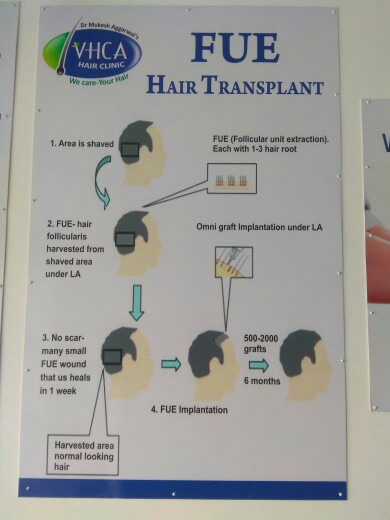 VHCA Hair Clinic - Gurgaon Image 12